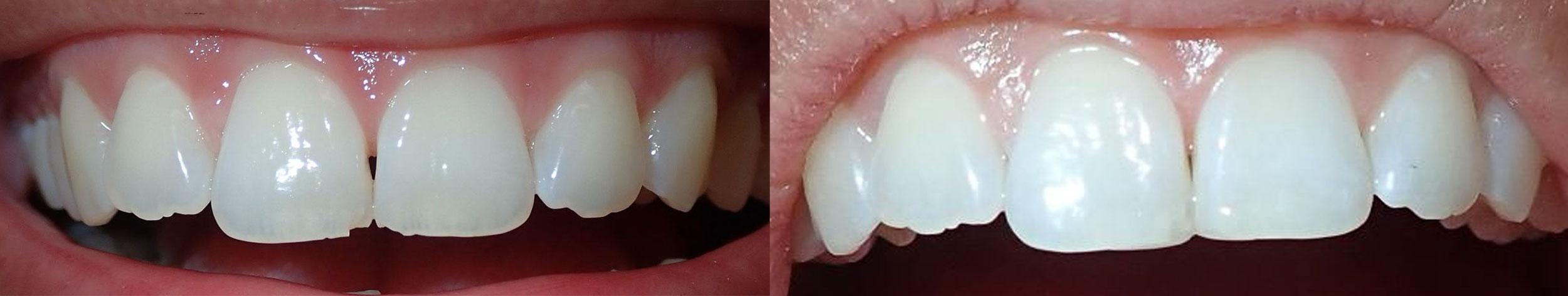 child with a chipped tooth needing dental procedure