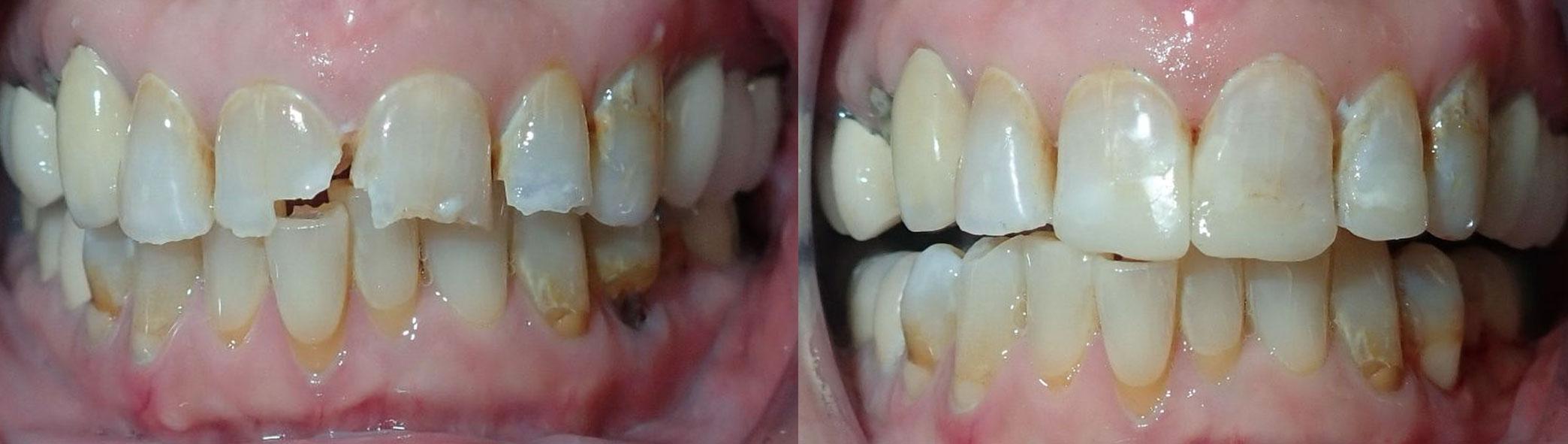 Composite fillings to repair damaged dentition